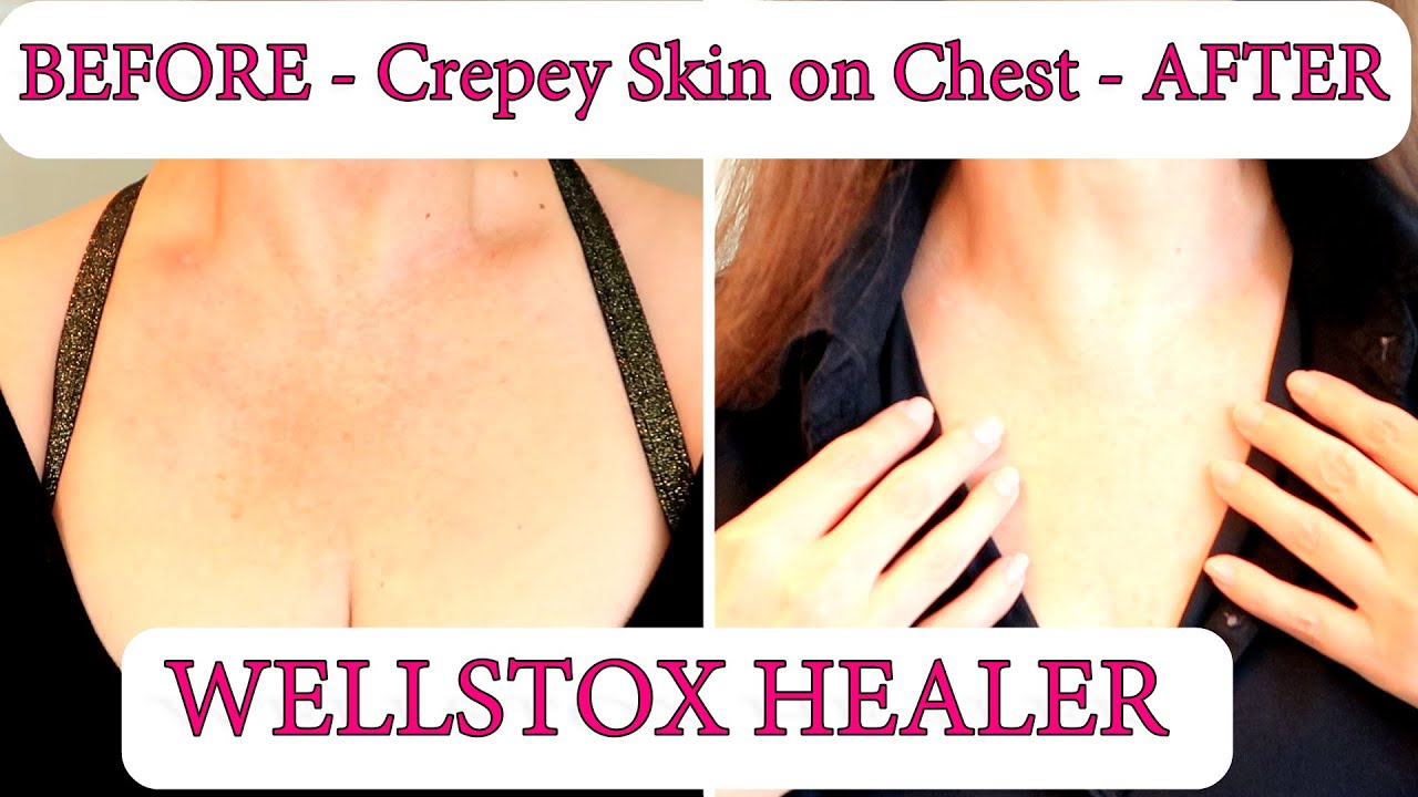 wellstox-healer-no-more-crepey-skin-and-sun-damage-on-chest-pdrn-skin
