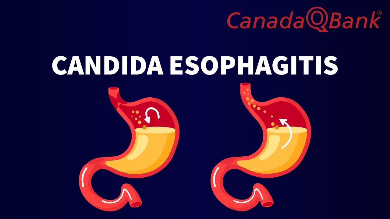 Candida Esophagitis - YouTube