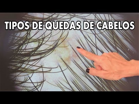 Tipos de queda de cabelos - Terapias Capilares