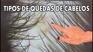 Tipos de queda de cabelos - Terapias Capilares