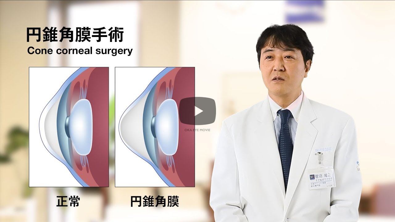 円錐角膜手術｜岡眼科クリニック