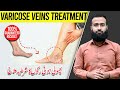 Varicose veins treatment  spider veins exercises  permanent results