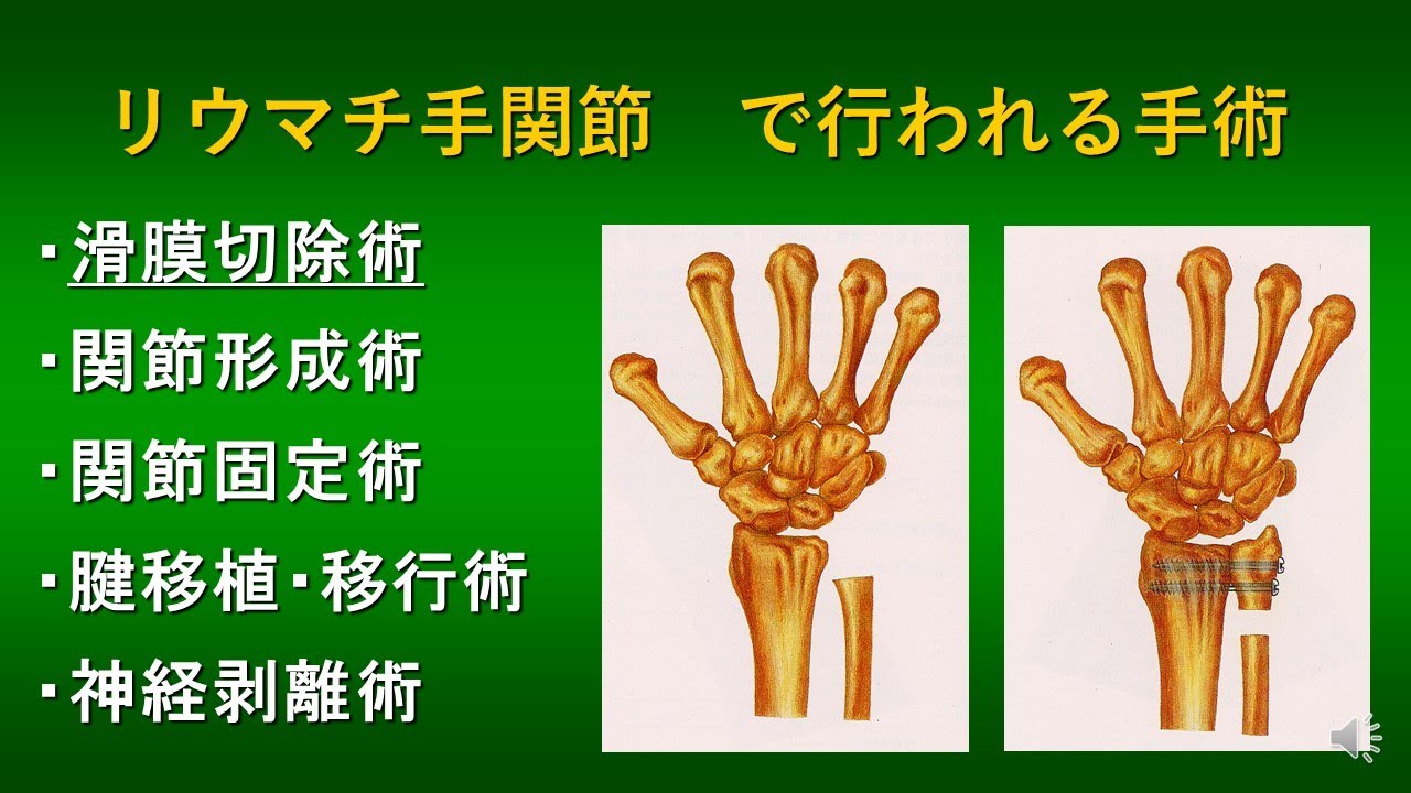 関節リウマチ 手関節の障害で行われる手術 ～当院での治療例を中心に
