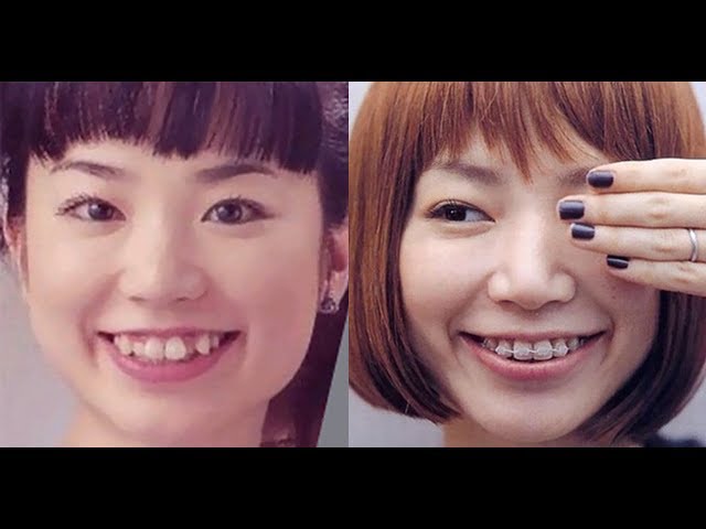 芸能人は歯が命 芸能人の歯並びの矯正before After 全然違う Youtube