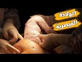 الولادة القيصرية خروج الجنين من بطن امة