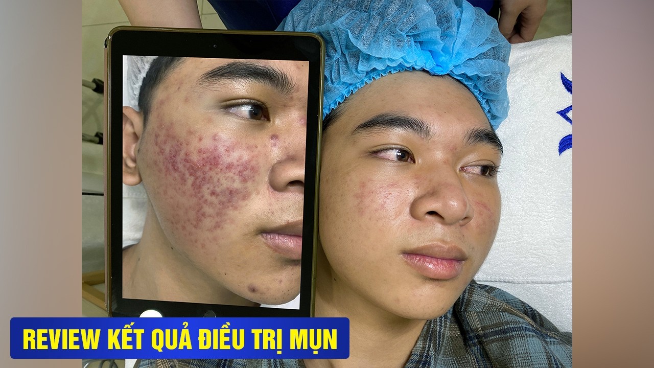 MỤN VIÊM TOÀN MẶT GIẢM 80% CHỈ SAU 1 BUỔI PIXEL MASTER.