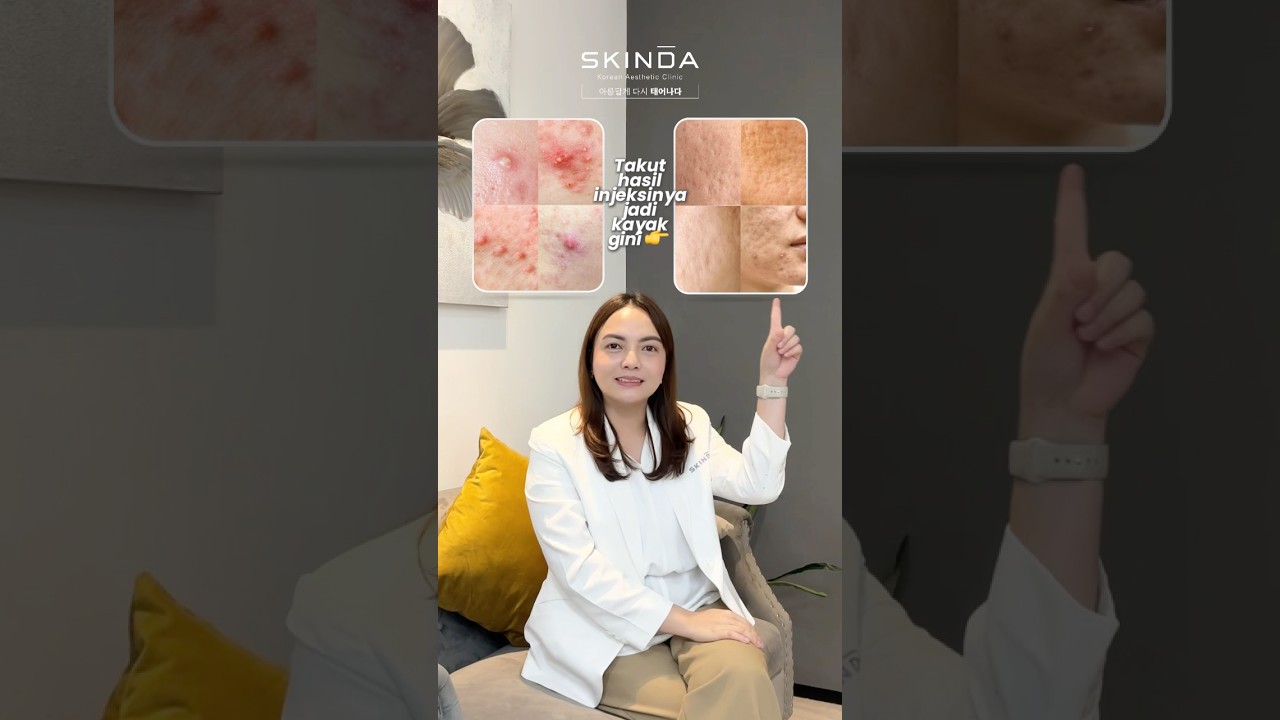 Skinda Beauties, suntik jerawat memang bisa bikin bopeng, KALAU…🫣