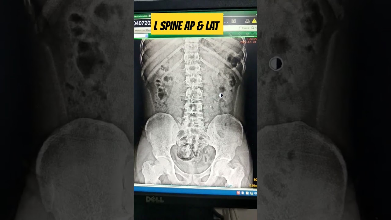 L SPINE AP & LAT 