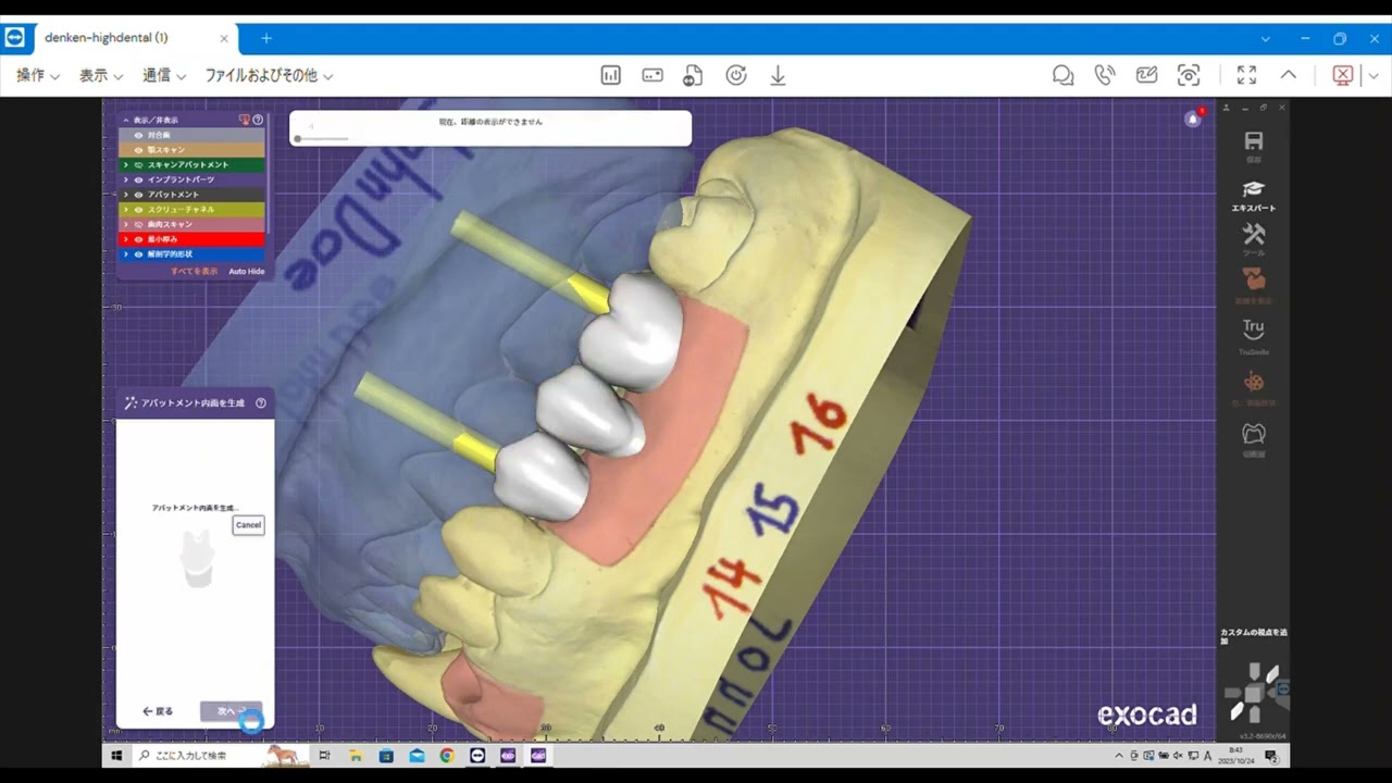 how-to-exocad-インプラントモジュール-カスタムアバットメント-上部構造設計