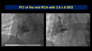 COMPLICATION BOOTCAMP: MY WORST COMPLICATION - Sheila Sahni, MD