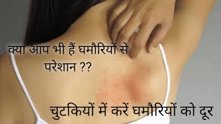 घमौरियों के लिए घरेलू उपाय ।।Home Remedies To Cure Prickly Heat Rash ।।