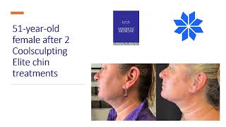 H's Coolsculpting Journey