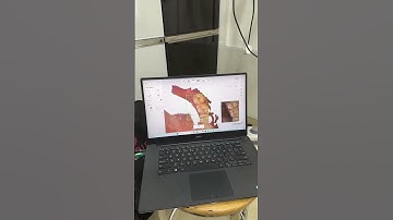 3D scanning for clear aligners #clearaligners #smiledesigner #smiledesign contact us 8891426652