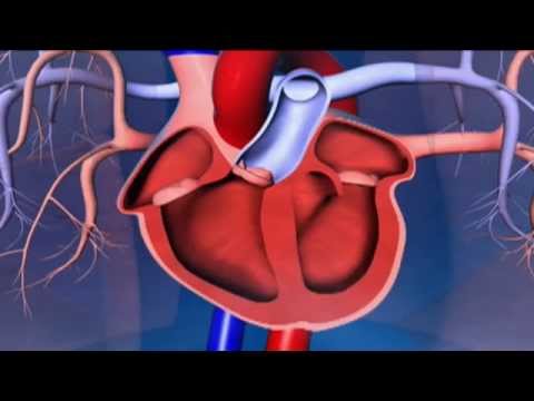 Wideo: Która tętnica jest przyczyną wdowy?
