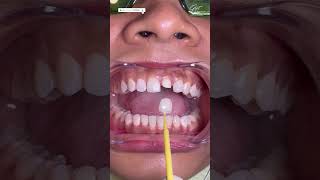 Dental Capping Treatment | Dental Crown Procedure Front Teeth- #zirconiacrown #dentalcrowns #shorts