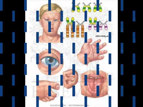 خصائص متلازمة داون 