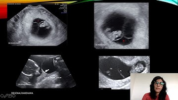 Black lambda sign- monochorionic diamniotic pregnancy