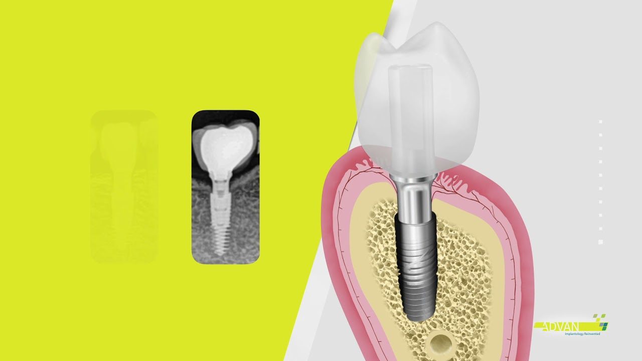 Capítulo 04 Gingival Former Abutment vs. Procedimiento estándar YouTube