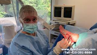 Dr. Brandon Nelson Performs Talar Fracture Surgery