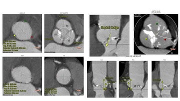 Cusp overlap commissural alignment using Medtronic EvolutR valve