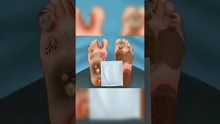 ASMR Treatment athletes foot and warts between toes at home | Foot care animation shorts