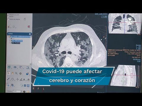 De neumonía a