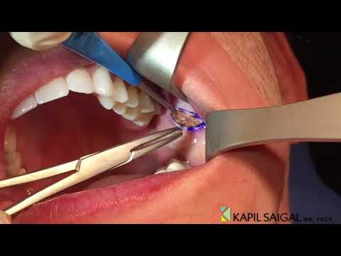 AWAKE Buccal Fat removal!