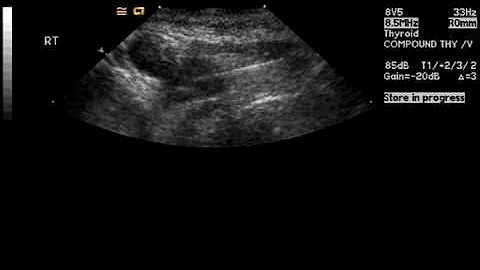 Ultrasound guided fine needle biopsy demonstrating the needle (white line) sampling the nodule