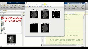 Brain Tumor Detection Using Image Processing Matlab Project Source Code