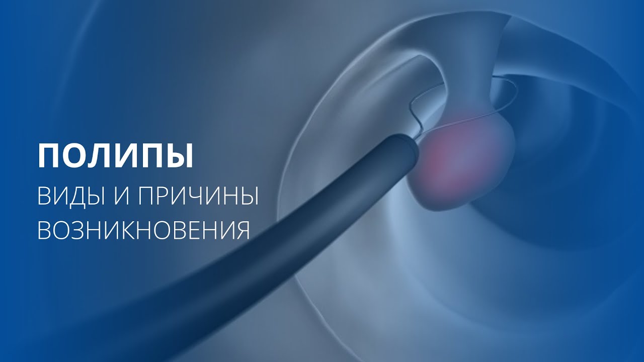 Полипы анального канала