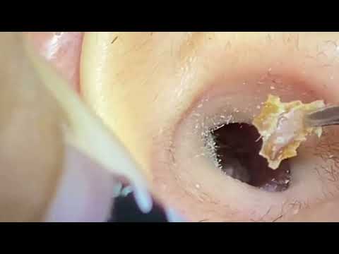ASMR Ear Cleaning – Doctor Said “This Is the Worst I’ve Seen”