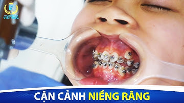 CẬN CẢNH NIỀNG RĂNG KHÔNG ĐAU TẠI NHA KHOA QUỐC TẾ VIỆT ĐỨC - NHA KHOA UY TÍN, CHẤT LƯỢNG Ở VIỆT NAM