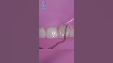 Class IV Direct Composite restoration