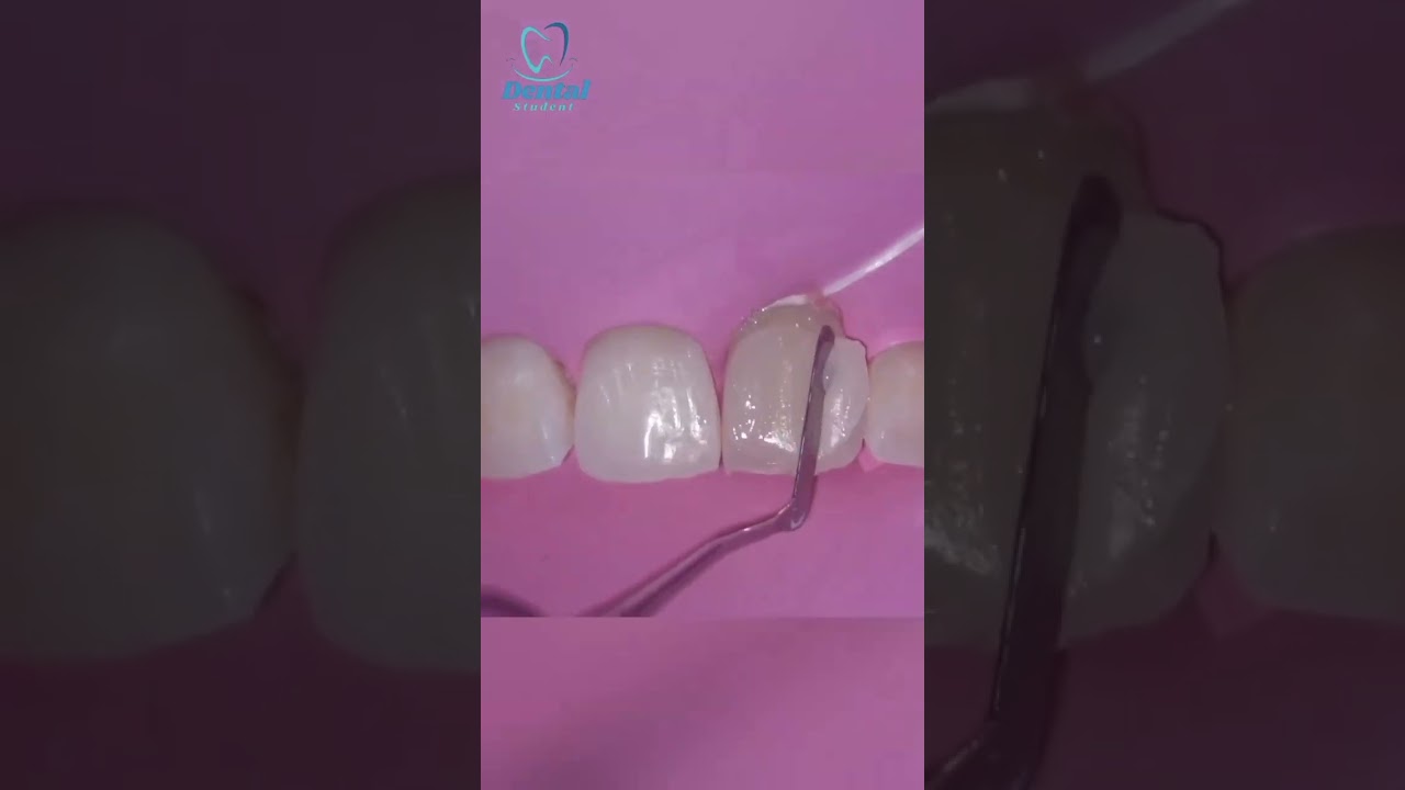 Class IV Direct Composite restoration