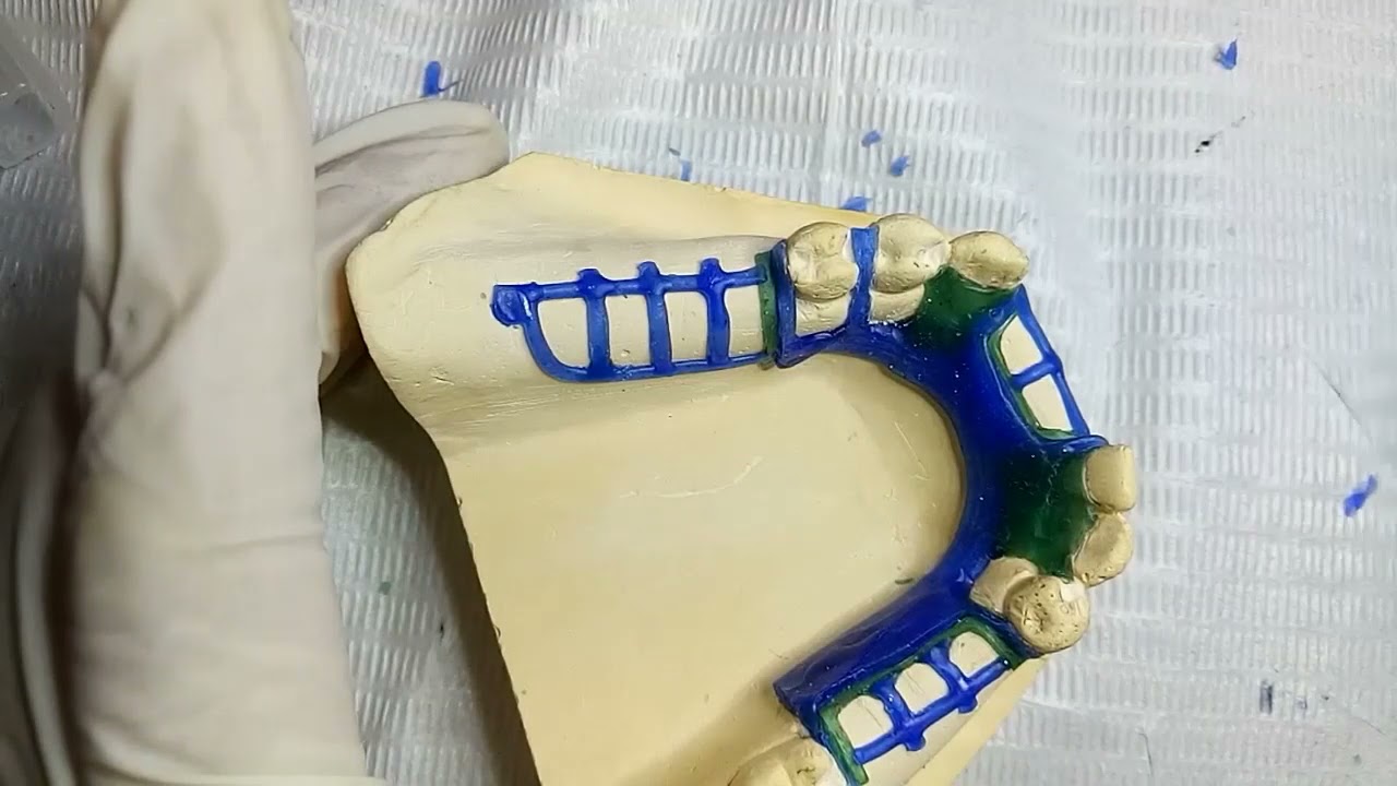 Dentistry Removable Partial Denture