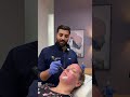 Microneedling VS Exosomes 👀 what’s the difference? | Banning Dental Group & Skin Clinique