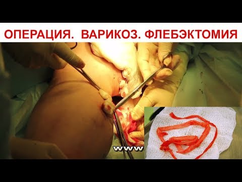 Операция по удалению варикозных вен. Флебэктомия в клинике Наука. | флебэктомия | расширение | варикозные | варикозное | удалению | операция | здоровье | клиника | варикоз | самара