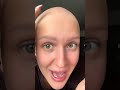 Pojawiły się pierwsze włoski !!! 😳 2 tygodnie leku za mną #alopecia #ritlecytynib #alopeciaareata