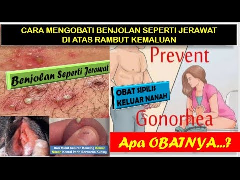 cara-mengobati-benjolan-seperti-jerawat-diatas-rambut-kemaluan-ll-obat-sipilis-keluar-nanah