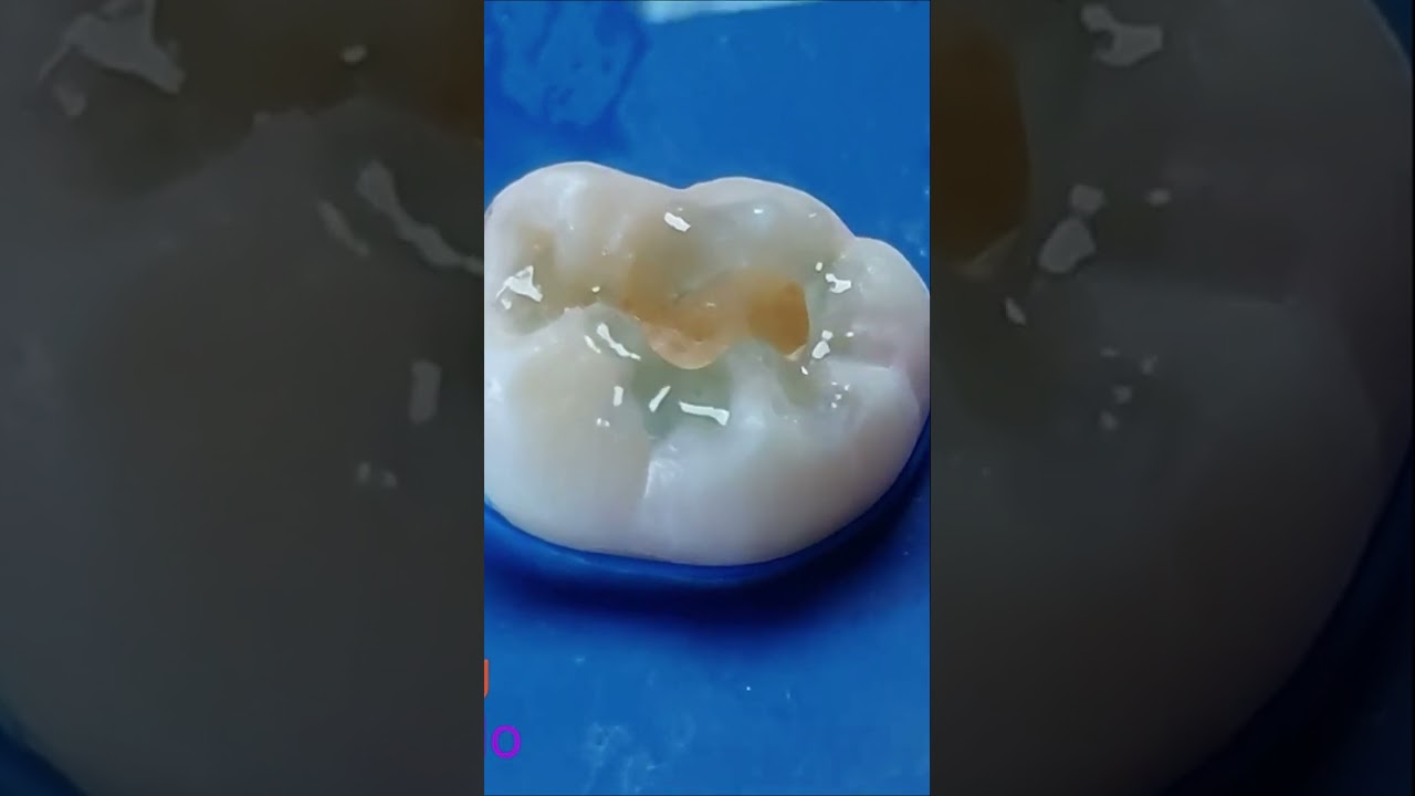 Acid etching / Grabado acido