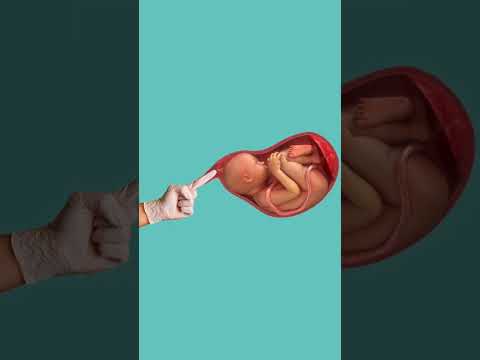 Getting A Membrane Sweep Laboranddelivery Childbirtheducation
