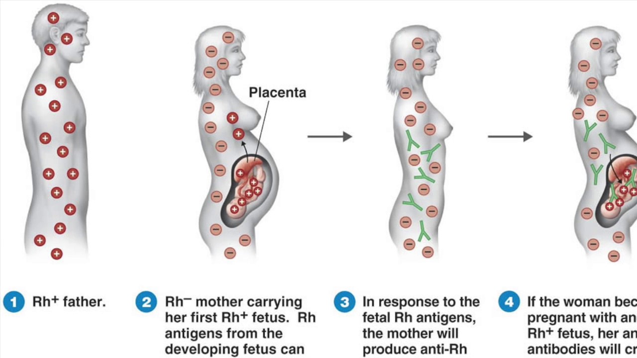 Кровь больной резус. Резус-конфликт при беременности. Резус фактор и беременность. Факторы риска резус-сенсибилизации.