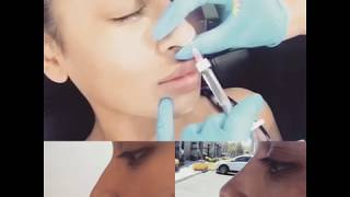 Flawless Non-Surgical Nose Job with Melanie Speed