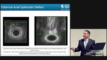 ICS 2014: Workshop 18 pt3 -  Management of bowel dysfunction following OASIS