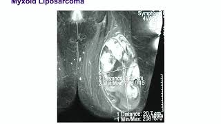Malignant Soft Tissue Tumors - ABOS Orthopedic Surgery Board Exam Review screenshot 4