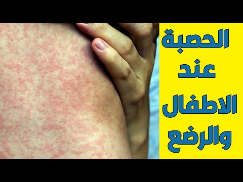 فيديو: الحصبة عند الأطفال: الأعراض والعلاج