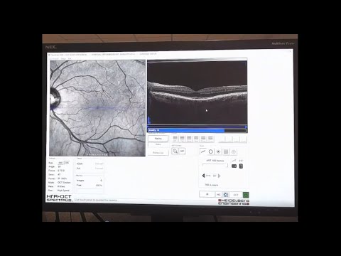 Recorded Webinar: OCT LIVE Virtual Workshop - Retina - video from Heidelberg Engineering