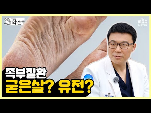 족부질환, 굳은살? 유전? [족부질환의 진단과 치료' ⑩] | 메디컬 약손