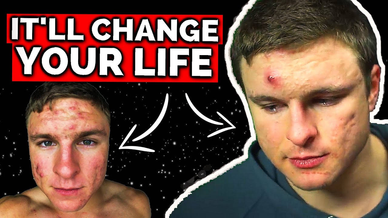 How To Stop HATING Yourself Because of Acne