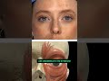 How to avoid getting toxin in lacrimal gland